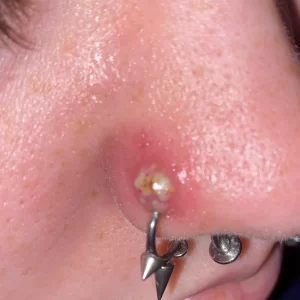 Extraccion de aros o pearcing de dificil remocion.