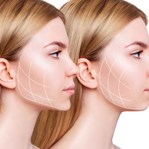 KUMA SHAPE X Adelgazamiento de contorno mandibular y tercio inferior del rostro