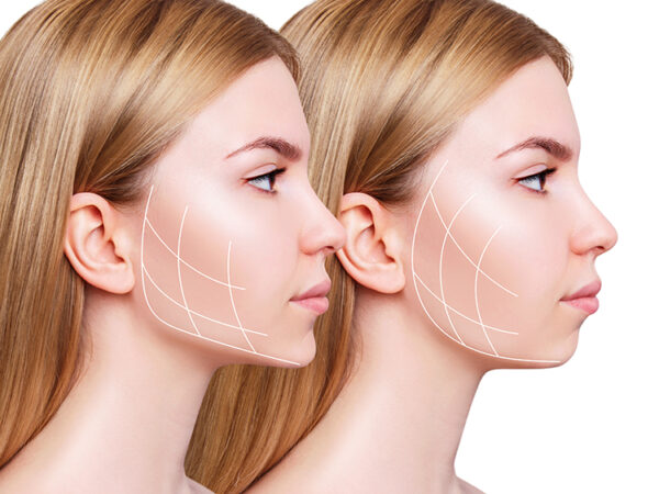 KUMA SHAPE X Adelgazamiento de contorno mandibular y tercio inferior del rostro